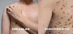 Pictures of Chicken Pox and Measles affected patients.